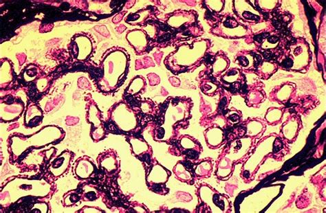spike and dome|membranous proliferative glomerulonephritis.